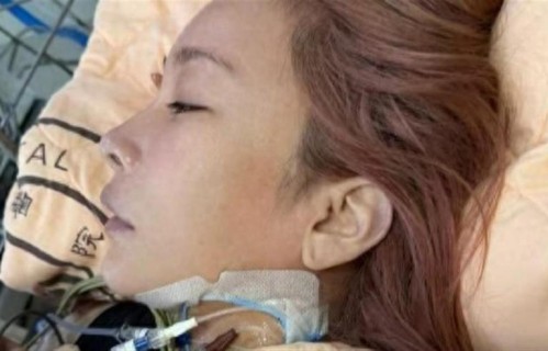 知名女歌手因结石引发败血症被送ICU，经10天抢救，已转至一般病房